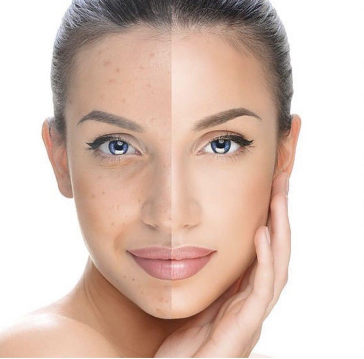 تاثیر استفاده از کرم پودر آنتی آکنه آموتیا روی زیبایی صورت
