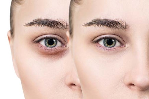 کاهش تیرگی زیر چشم قبل از آرایش